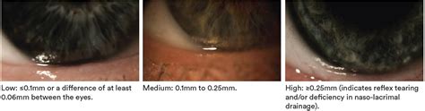 tear prism height test|How to assess and manage patients’ Tear Film Quantity.